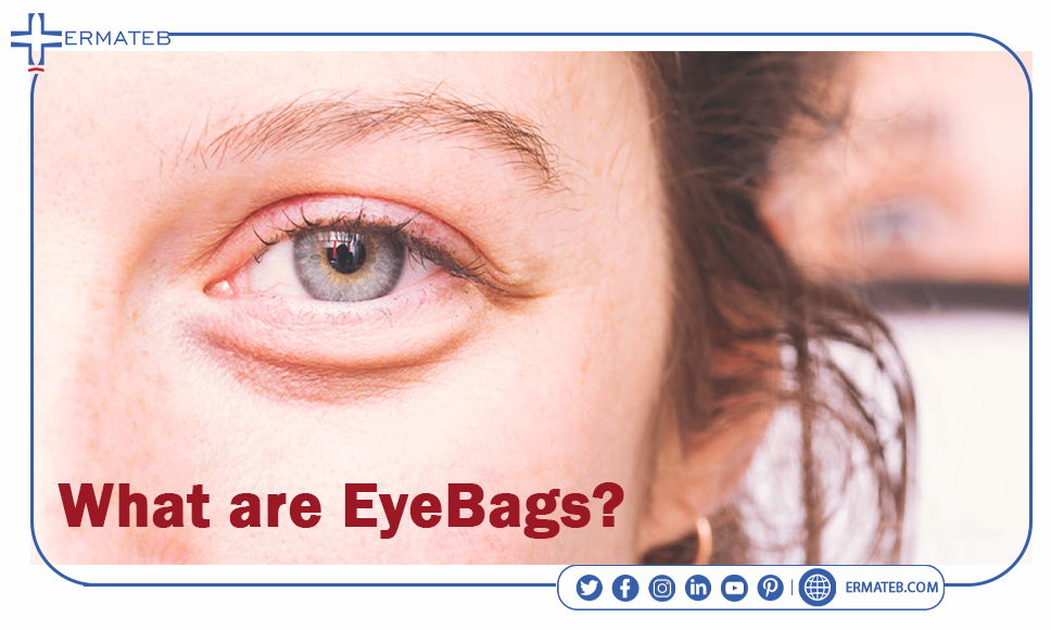 What are eyebags?